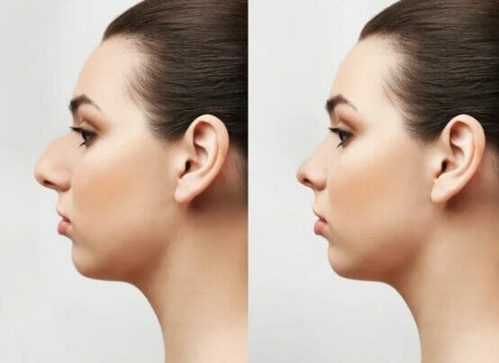 5 Common Nose Shape Issues Rhinoplasty Can Resolve