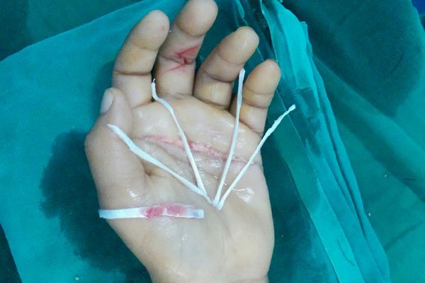 plastic surgery cost in Bhubaneswar