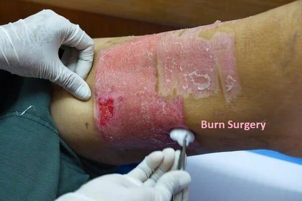 Burn surgery in Bhubaneswar