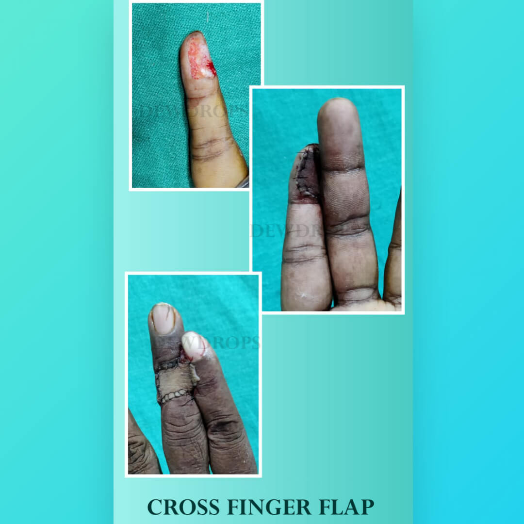Cross Finger Flap