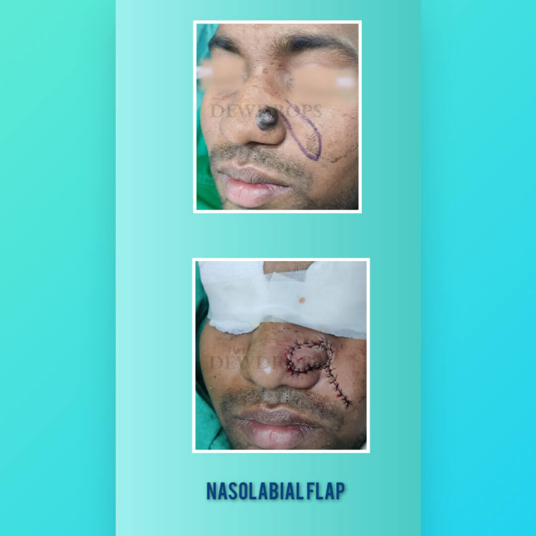 Nasolabial Flap